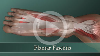 Plantar Fasciitis