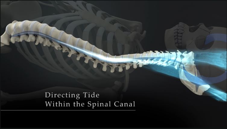 Directing Tide within the Spinal Canal