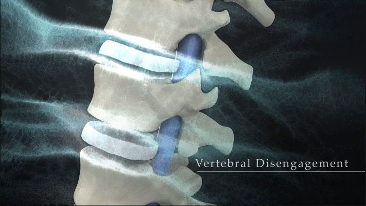 Vertebral Disengagement